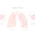 Understanding Asbestosis