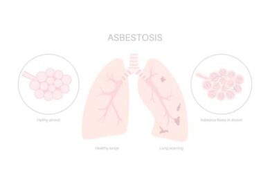 Understanding Asbestosis