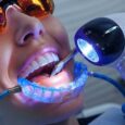 Common Mistakes People Make with Teeth Whitening